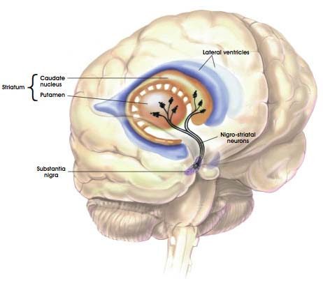 Parkinsons-disease2[1]