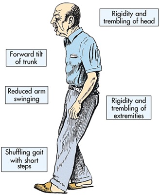 parkinsons-symptoms[1]